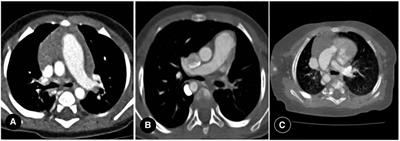 Proximal interruption of the pulmonary artery: A review of radiological findings